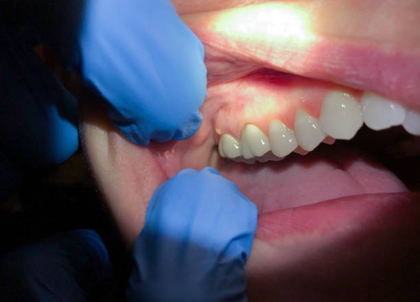 Best Urgent Care for Lost Fillings or Crowns in Clifton, TX