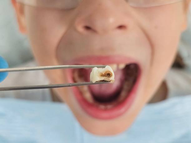 Best Emergency Wisdom Teeth Removal in Clifton, TX