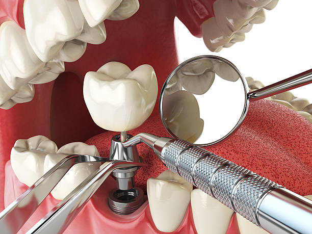 Best Emergency Treatment for Dental Infections or Abscesses in Clifton, TX